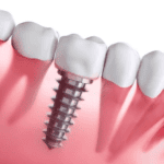 How Long Does It Take to Recover After a Dental Implant?