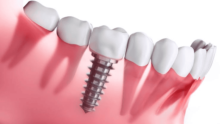 How Long Does It Take to Recover After a Dental Implant?